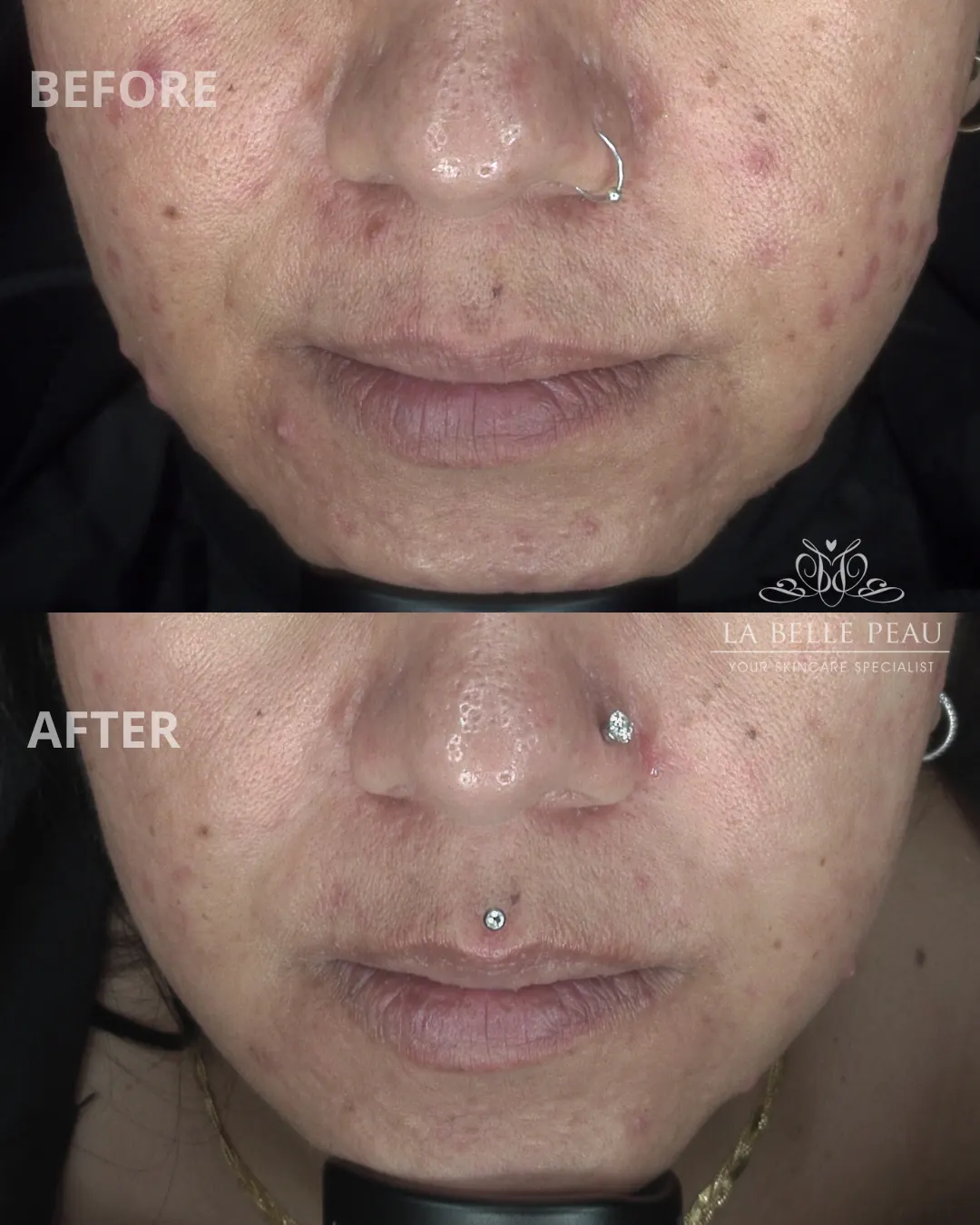 La Belle Peau client skin transformation before and after, result 6