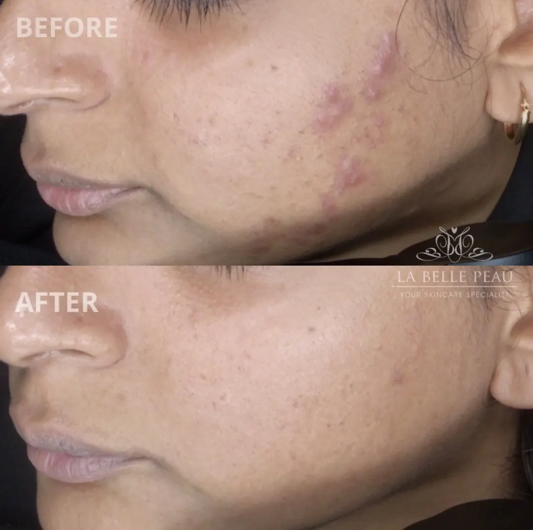 La Belle Peau client skin transformation before and after, result 8