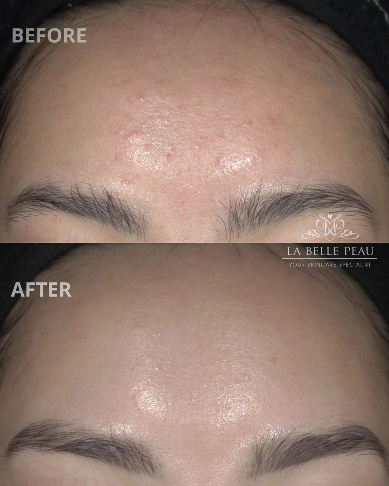 La Belle Peau client skin transformation before and after, result 4