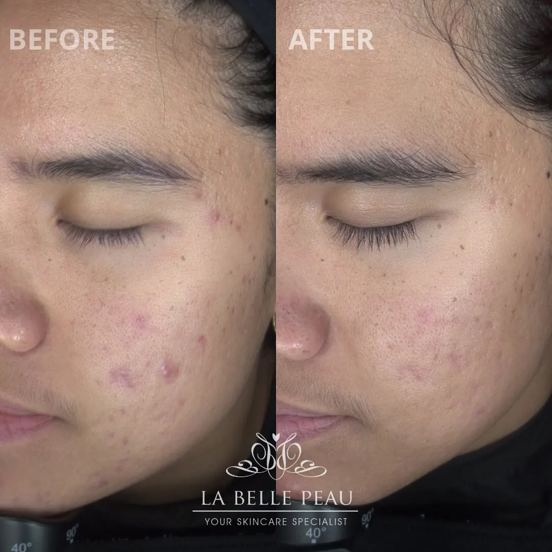 La Belle Peau client skin transformation before and after, result 1