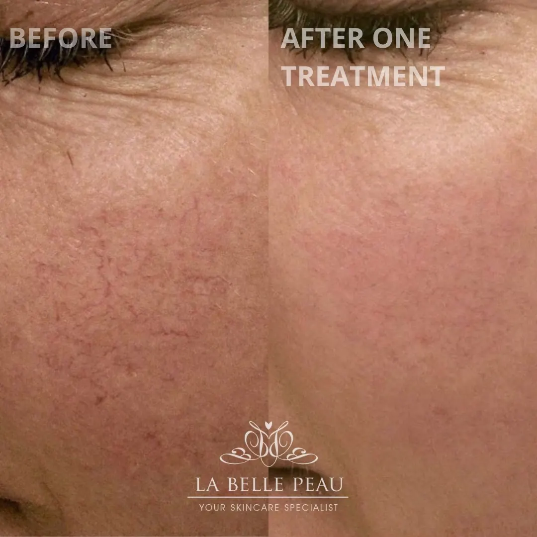 La Belle Peau client skin transformation before and after, result 7