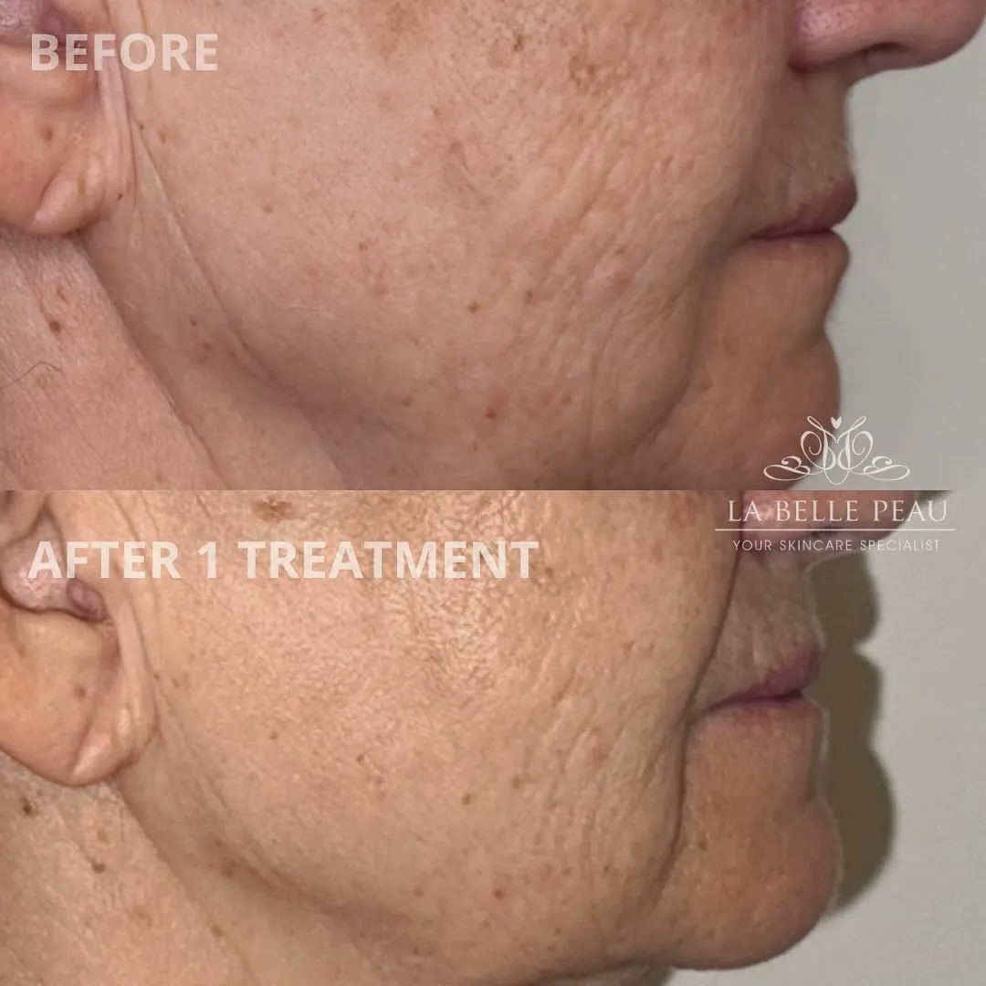 La Belle Peau client skin transformation before and after, result 2