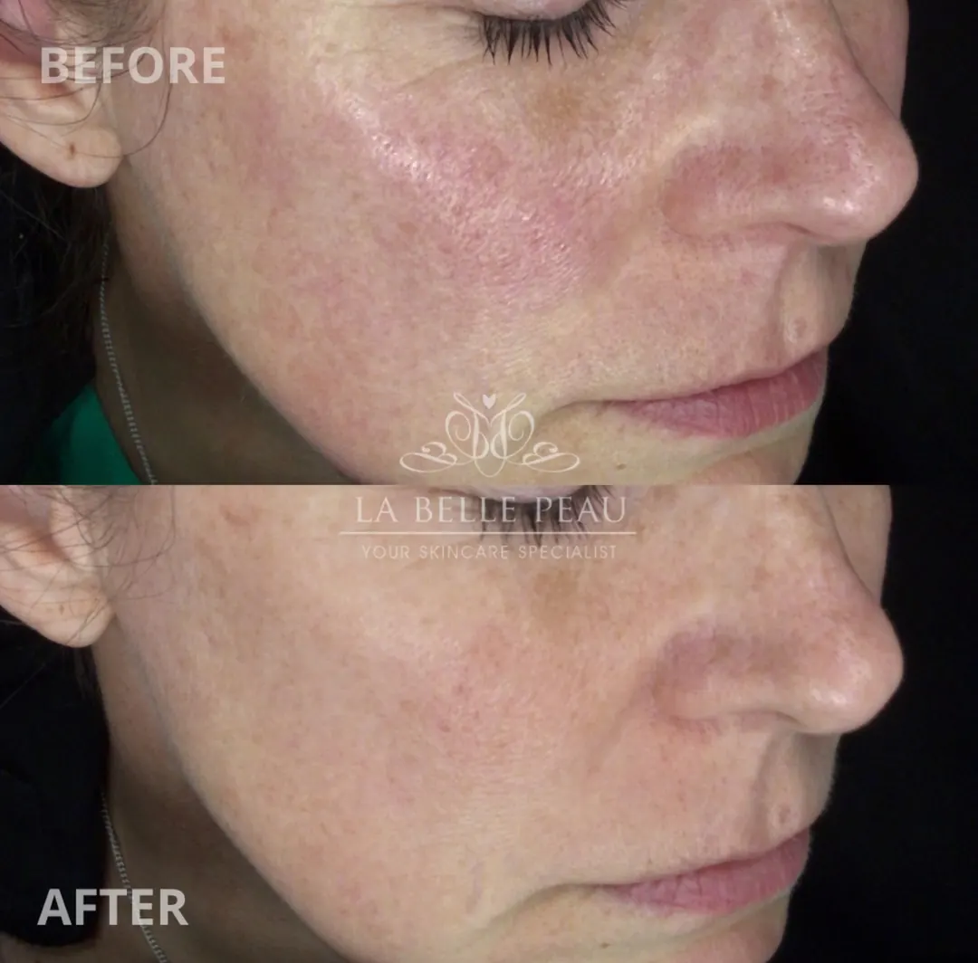 La Belle Peau client skin transformation before and after, result 3