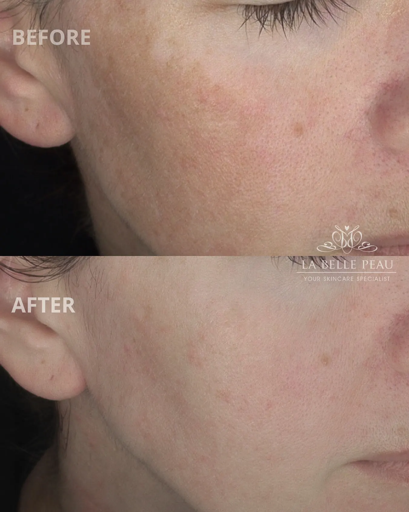 La Belle Peau client skin transformation before and after, result 5